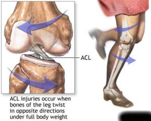 acl tear