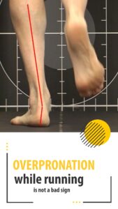 overpronation is normal