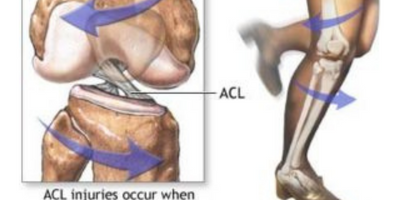 Prevention Exercises and Tips For ACL Injury