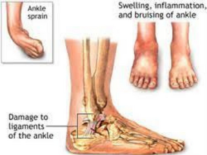 How To Deal With Ankle Sprains ?